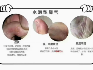脚上怎么分辨是湿疹还是脚气，一份清晰实用的鉴别指南